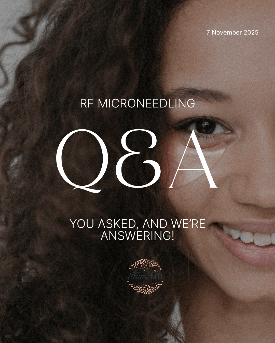 RF Microneedling Safety: What You Need to Know &amp; Why illumeMD Clients Can Feel Confident - illumeMD