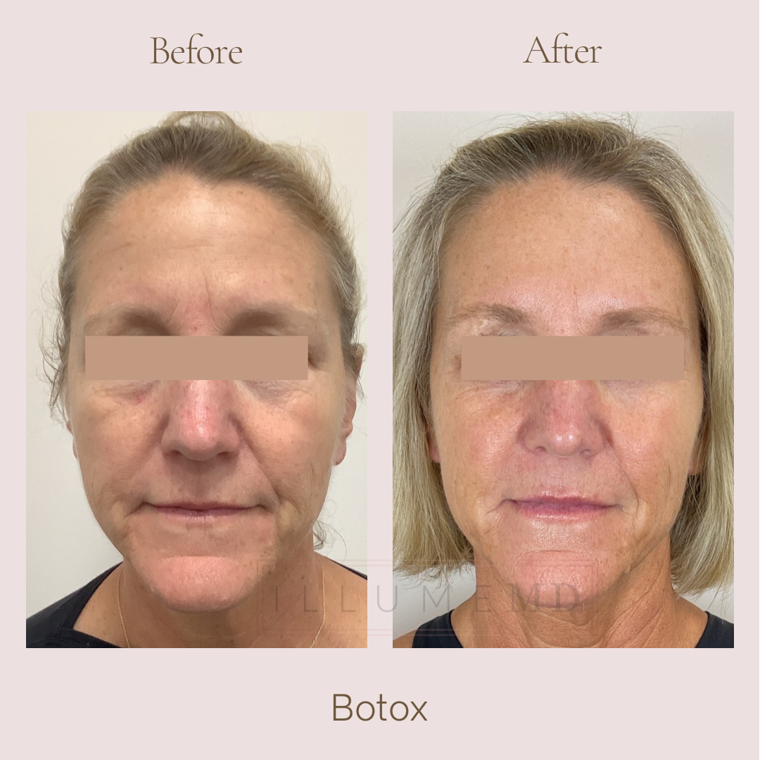 Before and after Sculptra and Botox treatment for natural facial rejuvenation