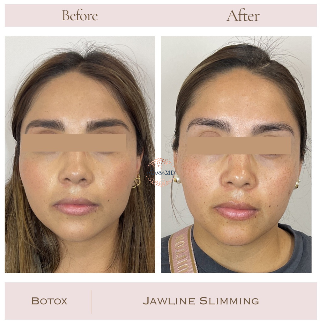 Before and after Botox for jawline contouring
