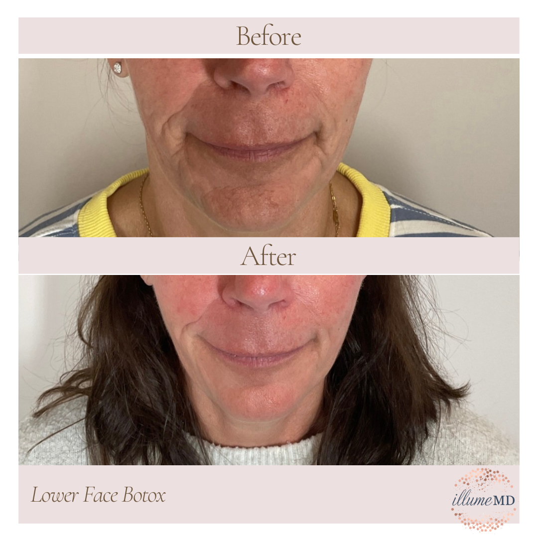 Botox treatment to soften lower facial muscle activity for a relaxed, natural appearance