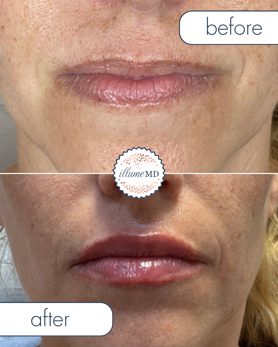 semaglutide and lip filler Lip fillers are a popular cosmetic enhancement that involves injecting hyaluronic acid or other substances into the lips to add volume, shape, definition. Here are some key points about fillers Plump Up Your Pout!