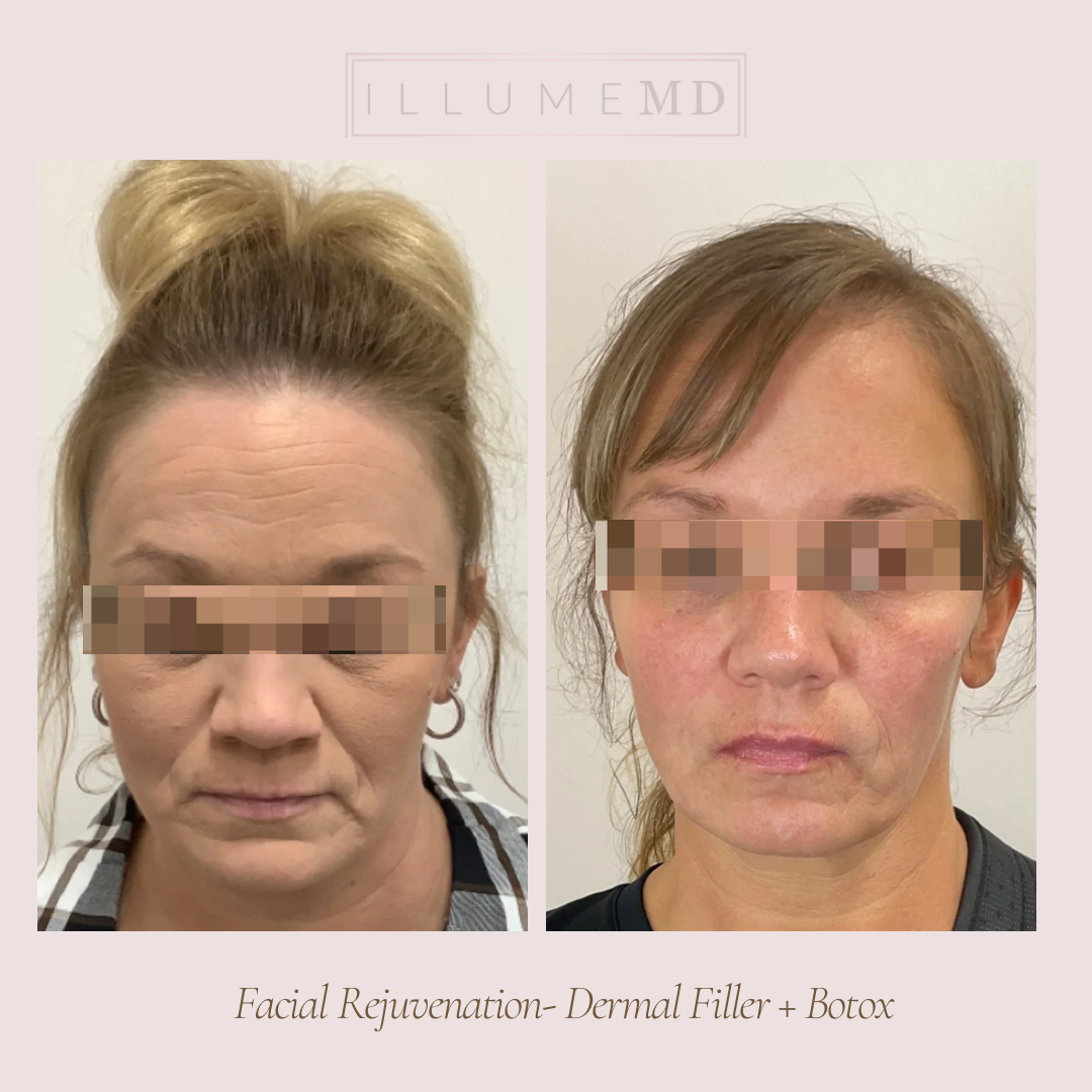A customized dermal filler approach that enhances facial symmetry and proportion for natural, balanced results.