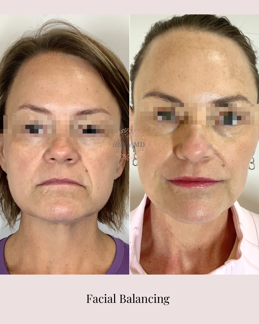 Before and after facial balancing treatment for natural, softened features