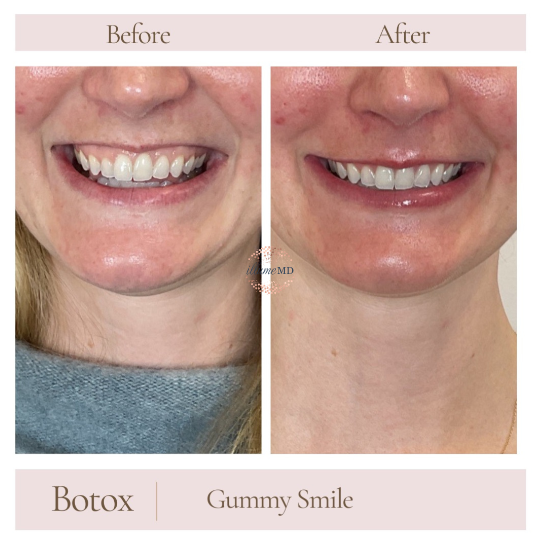 Botox treatment to reduce excessive gum show for a balanced smile